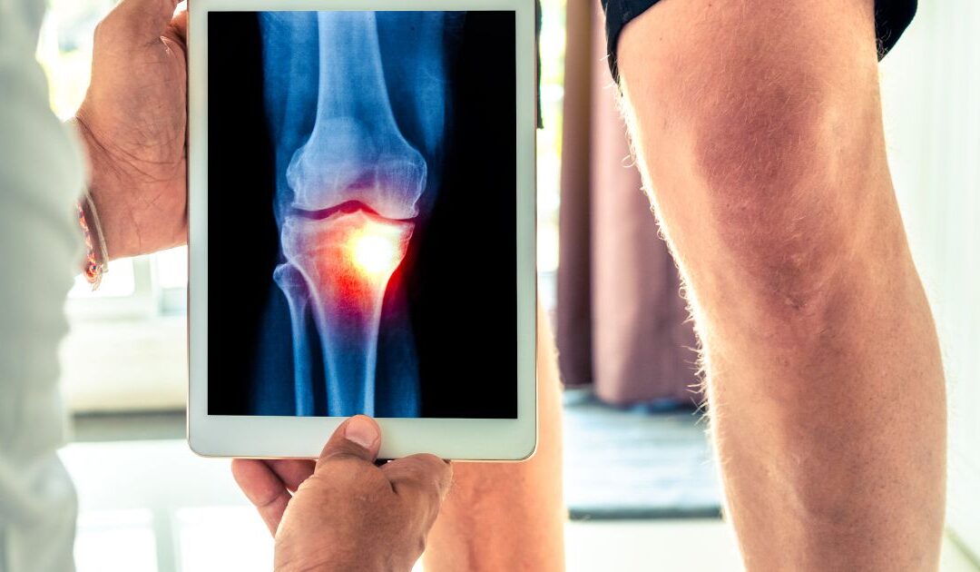 Artrosis de Rodilla: Tratamientos Eficaces para Aliviar el Dolor en Pain Clinic México