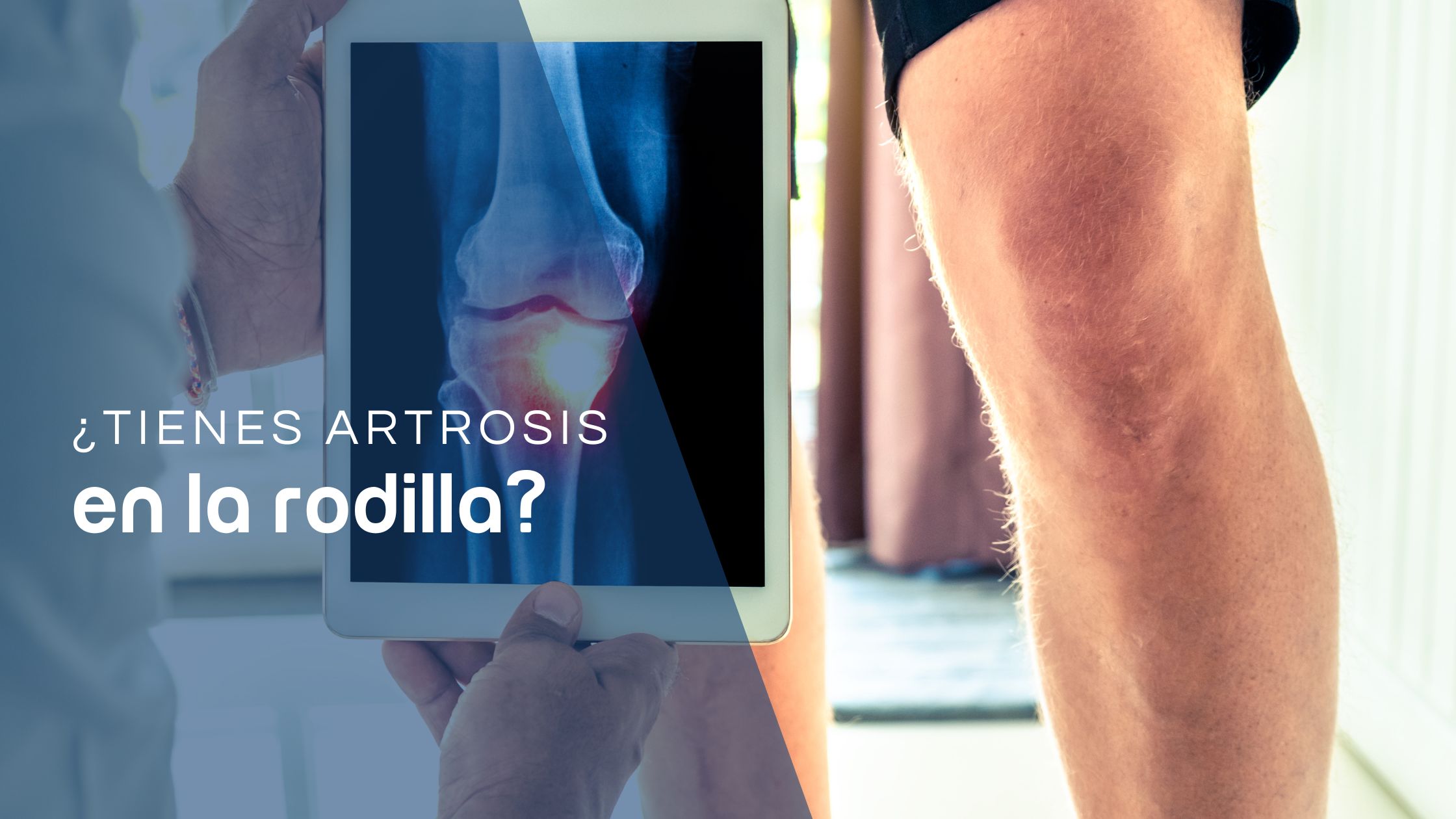 artrosis de rodilla