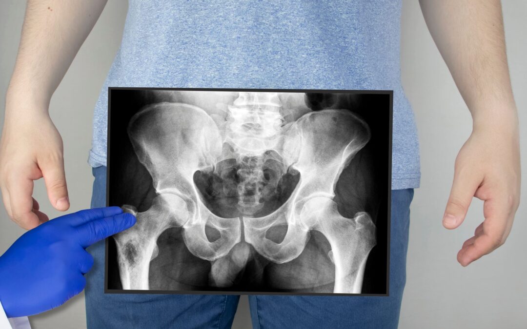 Dolor pélvico crónico en hombres y mujeres